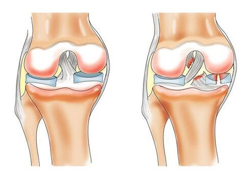 здраво колено и артроза на коленото зглоб