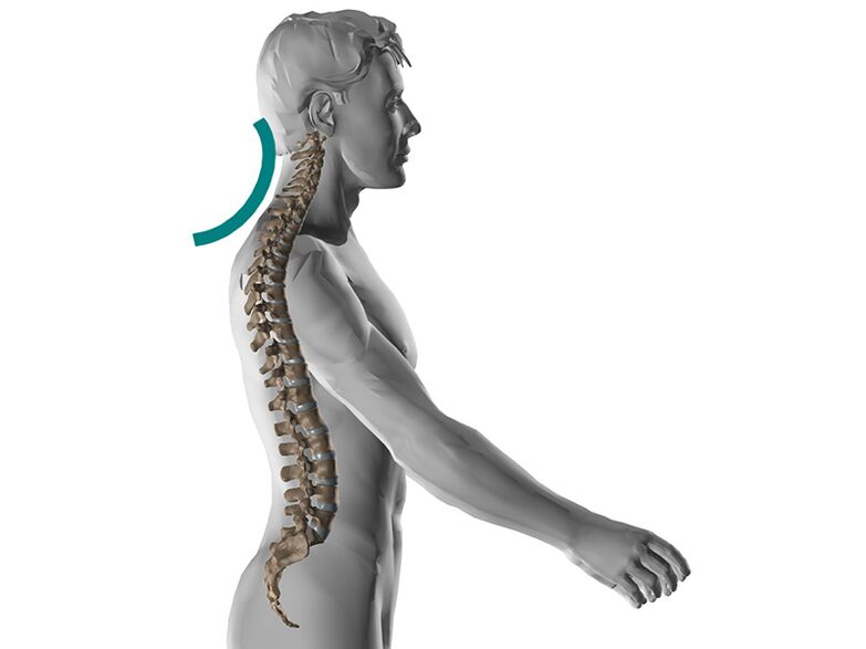 Цервикална остеохондроза на 'рбетот, предизвикувајќи многу непријатни симптоми